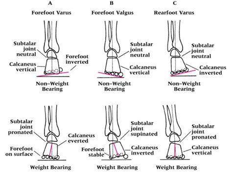 Forefoot varus and patellofemoral cartilage damage. — The Gait Guys