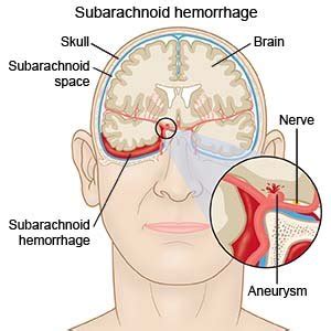 Subarachnoid Hemorrhage (Discharge Care)