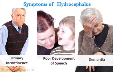 Hydrocephalus - Types, Causes, Symptoms, Diagnosis, Treatment, Health Tips