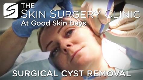 Cyst Removal from £425 - Leeds Bradford - Skin Surgery Clinic