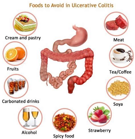 LIVING WITH ULCERATIVE COLITIS | Ulcerative colitis diet, Ulcerative ...