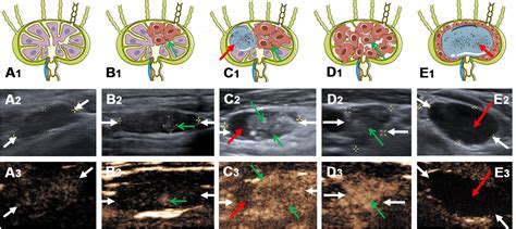 Frontiers | Value of Contrast-Enhanced Ultrasound for Evaluation of ...