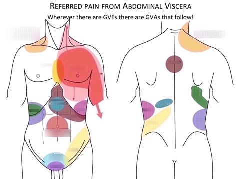 [Abdomen] Referred pain Diagram | Quizlet