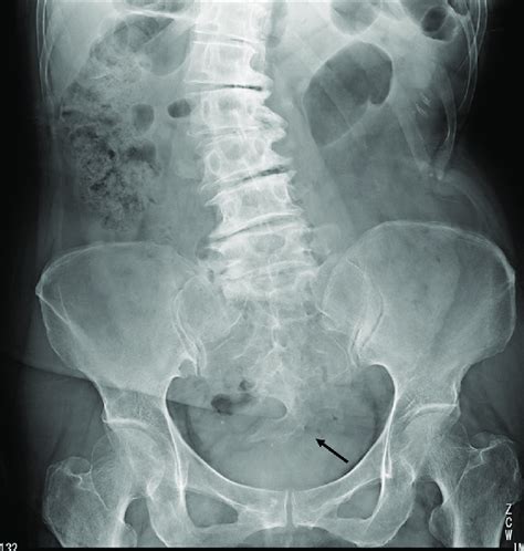 Open Book Pelvic Fracture X Ray