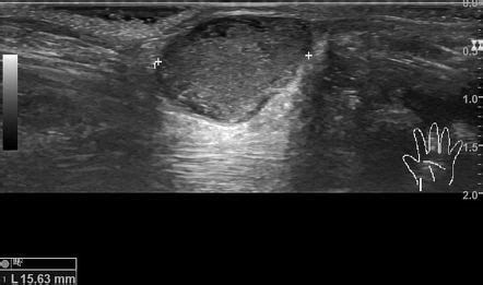 Ganglion Cyst Ultrasound