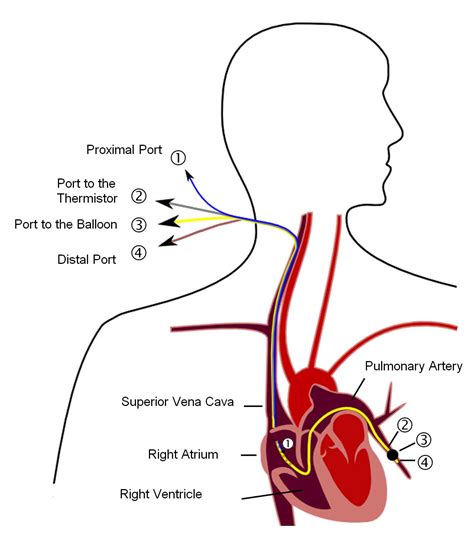 File:Pulmonary artery catheter english.JPG - Wikimedia Commons