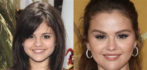 Selena Gomez: Plastic Surgery or Lupus? Why Fans are Wrong