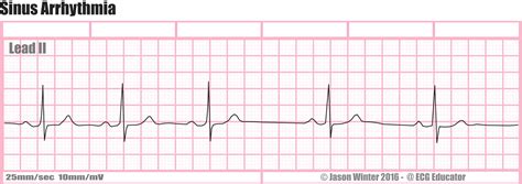 ECG Educator Blog : Sinus Arrhythmia