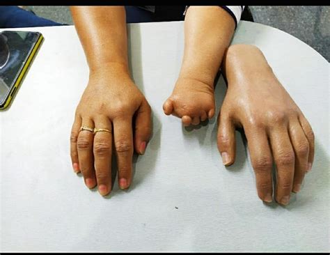 Upper Limb Silicone Partial Hand Prosthesis at Rs 65000 in Lucknow | ID ...