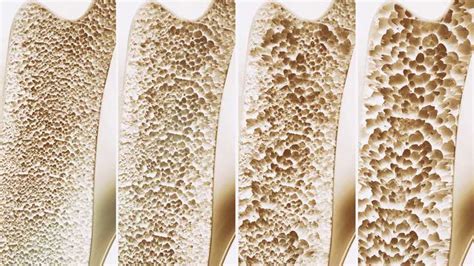 Osteoporosis Vs Osteopenia -Let’s know the difference - Steamdaily