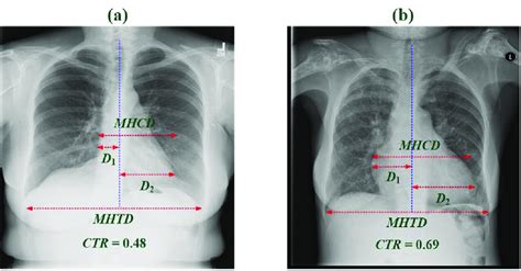 Cardiothoracic ratio (CTR) estimation on posteroanterior chest X-ray ...