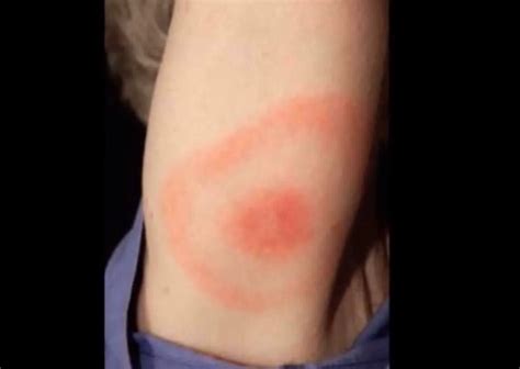 Brown Recluse Bite: Pictures, Stages, Symptoms & Treatment | HubPages