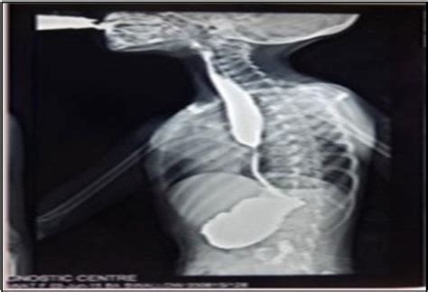 Figure 2 from Evaluation and management of congenital esophageal ...