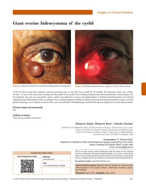 (PDF) Giant eccrine hidrocystoma of the eyelid