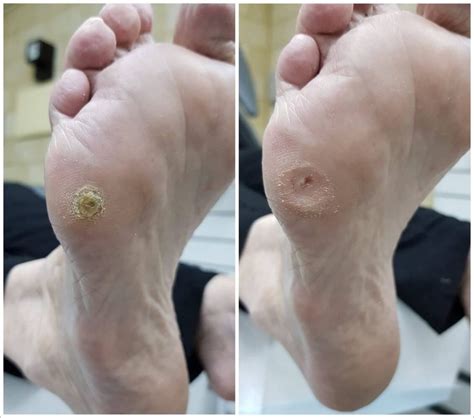 Callous & Corns On Feet: Similarities To Blisters | Blister Prevention