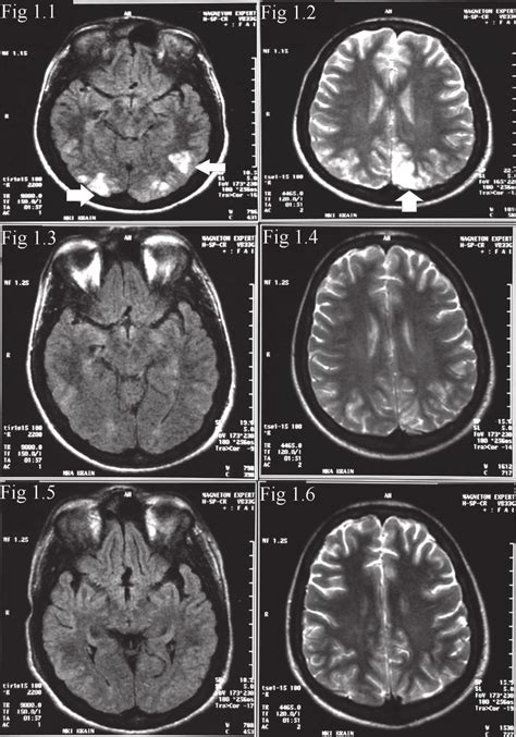 FlAir (1.1) and t2 (1.2) images of initial Mri study showing ...