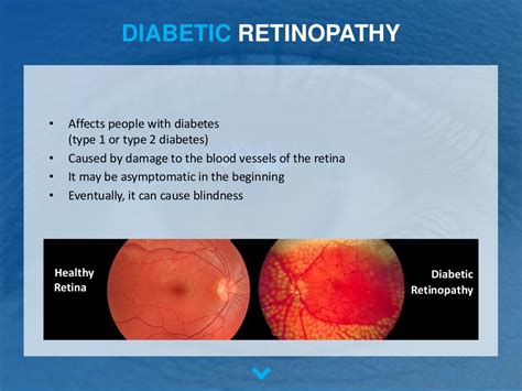 The Most Common Retinal Diseases