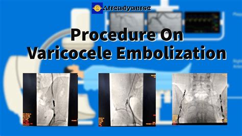 #Varicocele #Embolization @Procedure On Varicocele Embolization - YouTube