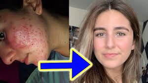 accutane before and after 8 | Public Health