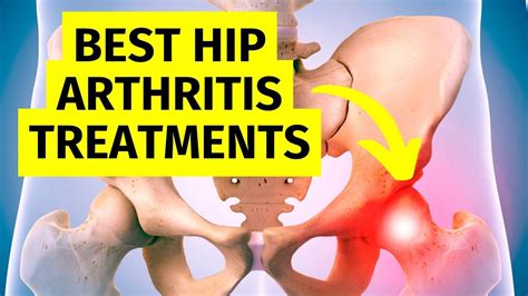 The Best Hip Arthritis Treatments Without Surgery - YouTube