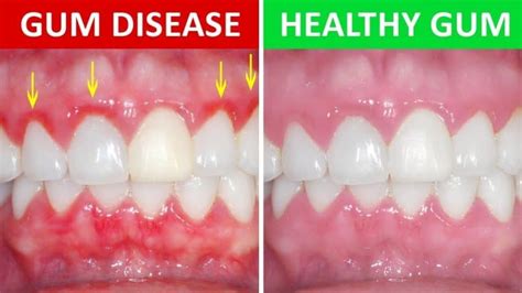 Bleeding Gum Dentist: 3 Stages of Periodontal Disease - Know The Signs