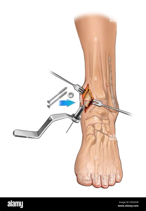 Medial Malleolus Ankle Fracture : The Radiology Assistant Ankle ...