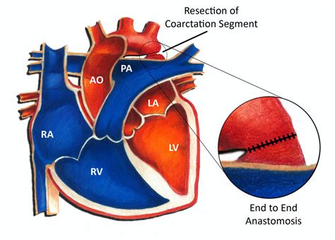 Coarctation of the Aorta - Surgery - Pediatric Heart Specialists