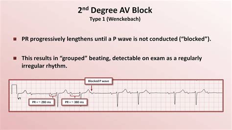 Ecg Blocks Made Easy