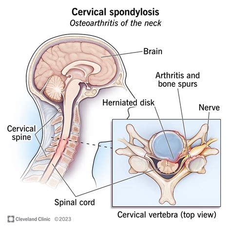 Cervical Spondylosis