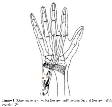 Atypical Extensor Medii Proprius – A Case Report