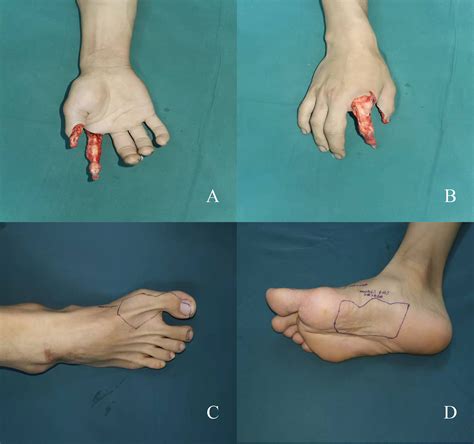 Combined great toe dorsal nail-skin flap and medial plantar flap for ...