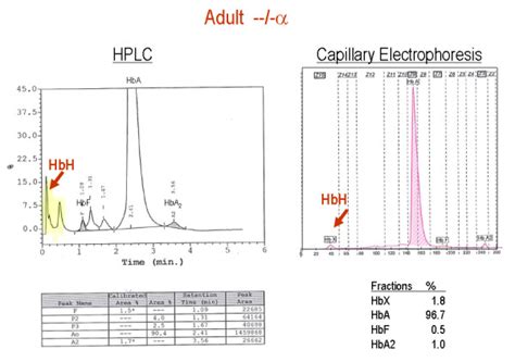 HPLC and Capillary Hb electrophoresis patterns of an adult with HbH ...