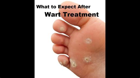 Plantar Warts: Home Care - YouTube