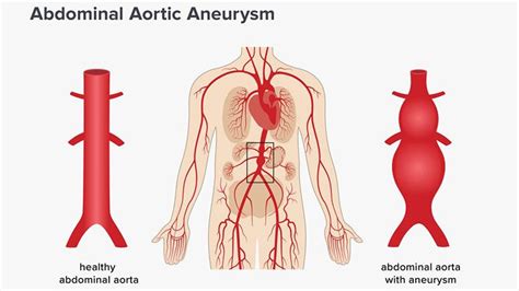 Aneurysm – Types, Symptoms & Causes – Page 3 – Entirely Health