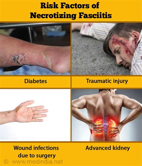 Necrotizing Fasciitis (NF) | Flesh-Eating Disease - Causes, Risk ...