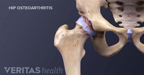 Osteoarthritis Complete Treatment Guide