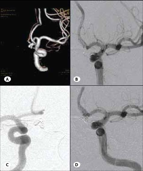 Figure 1 from A combined bilateral approach to anterior communicating ...