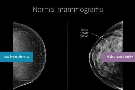 mammogram_breast_density - Wellend Health