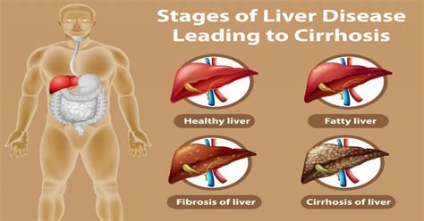 What are the Early Signs and Treatment of Liver Disease