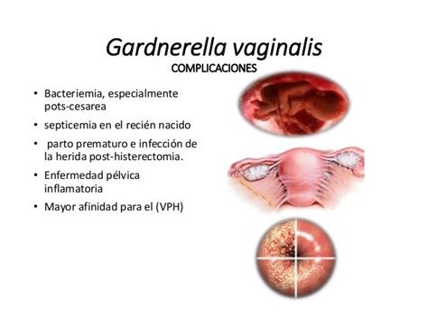 Gardnerella - příznaky, diagnostika a léčba tohoto častého onemocnění u žen