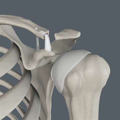 Shoulder Replacement Frisco TX | Shoulder Arthroscopy Frisco TX