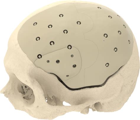 CRANIOPLASTY - Patient concept | CADskills