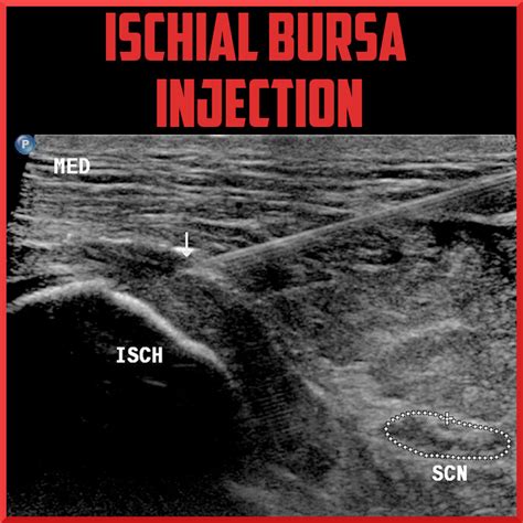 Ischial Bursitis