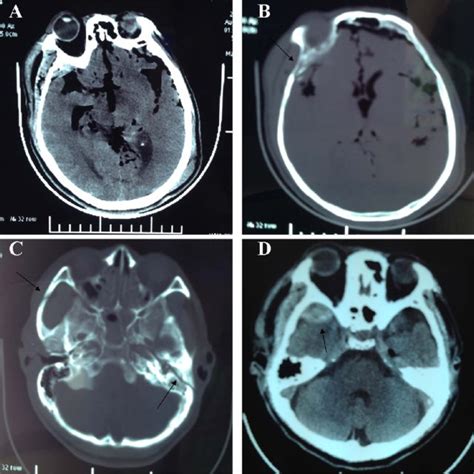 (PDF) Traumatic Middle Meningeal Artery Pseudoaneurysms Presenting with ...