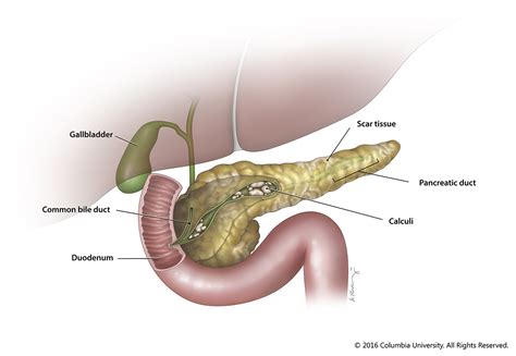 How Quickly Does Pancreatitis Develop