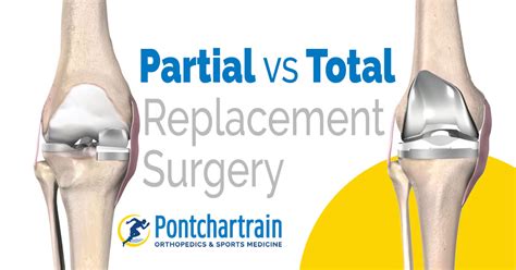 Partial vs Full Knee Replacement - Pontchartrain Orthopedics