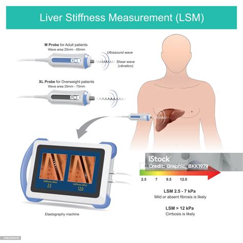 Liver Stiffness Measurement Measuring Tissue Liver Stiffness In ...