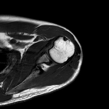 Reverse Hill-Sachs lesion | Radiology Reference Article | Radiopaedia.org