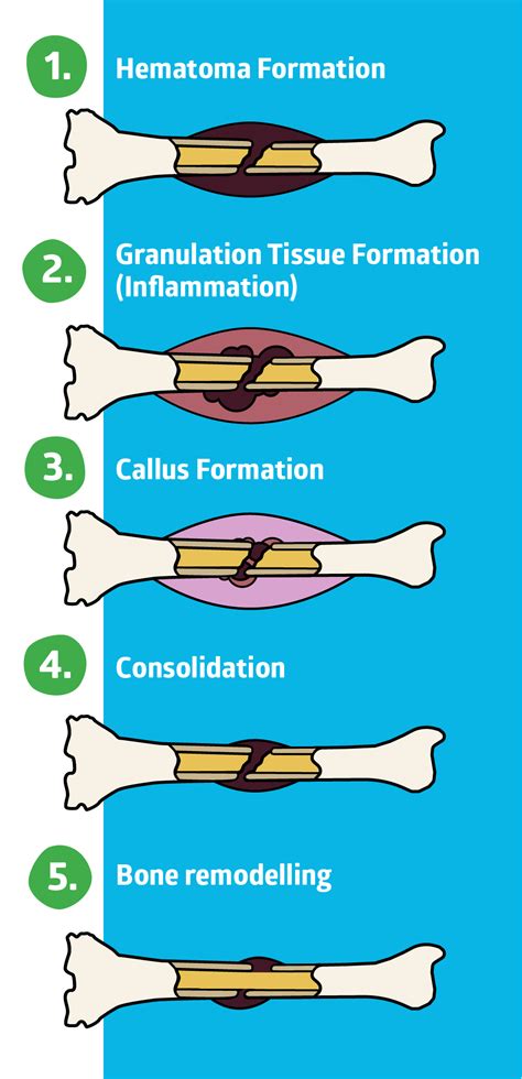 Stages Of Bone Fracture Healing