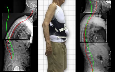 KyphoBrace - kyphosis Custom Bracing,ScoliCare Naples Florida